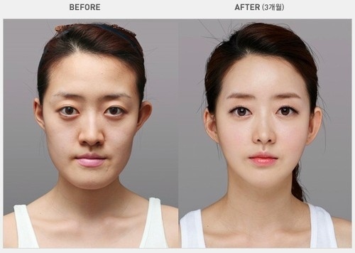 Corea del sur Cirugía plástica