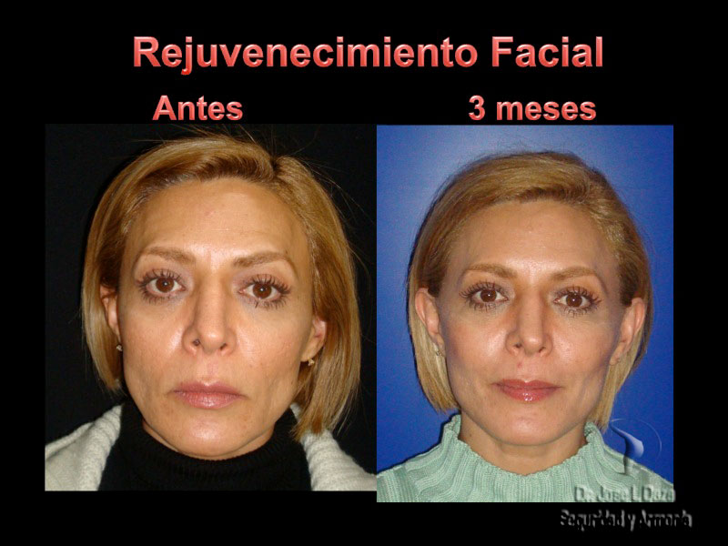 rejuvenecimiento facial lifting cirugía plastica