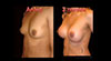 Aumento senos implante